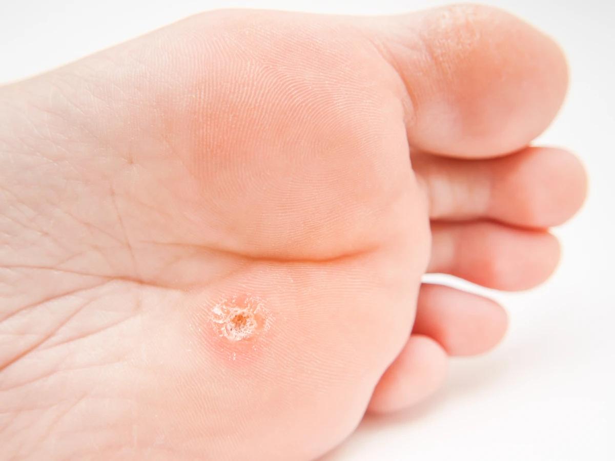 Pedicure leczniczy - co o nim wiedzieć warto?