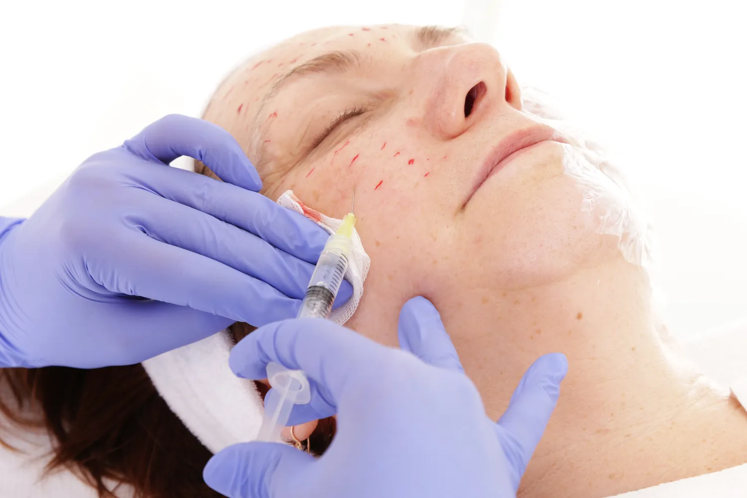 Jak długo układa się kwas hialuronowy w ustach?