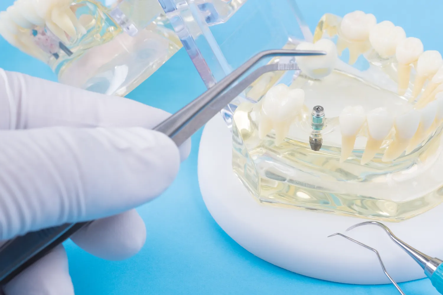 Implanty w jeden dzień Stargard